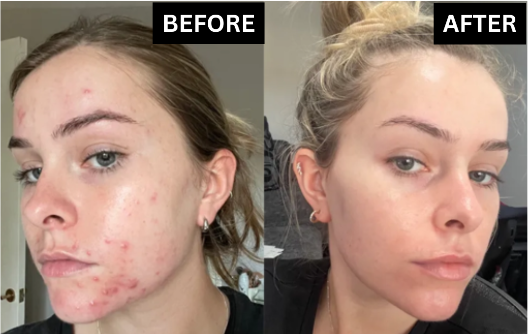 Ultra Acne Control Gel