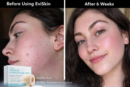 The Viral Hydrocolloid Tape That Heals & Protects Your Skin