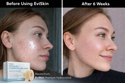 The Viral Hydrocolloid Tape That Heals & Protects Your Skin