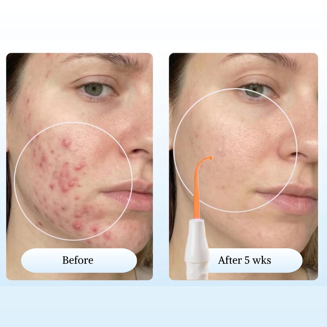 High Frequency Wand For Acne Spots