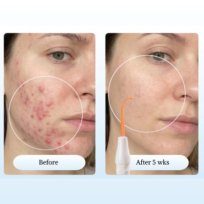 High Frequency Wand For Acne Spots